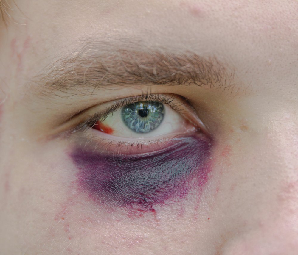 Un œil avec un hématome autour, présentant des marques violettes et rouges.
